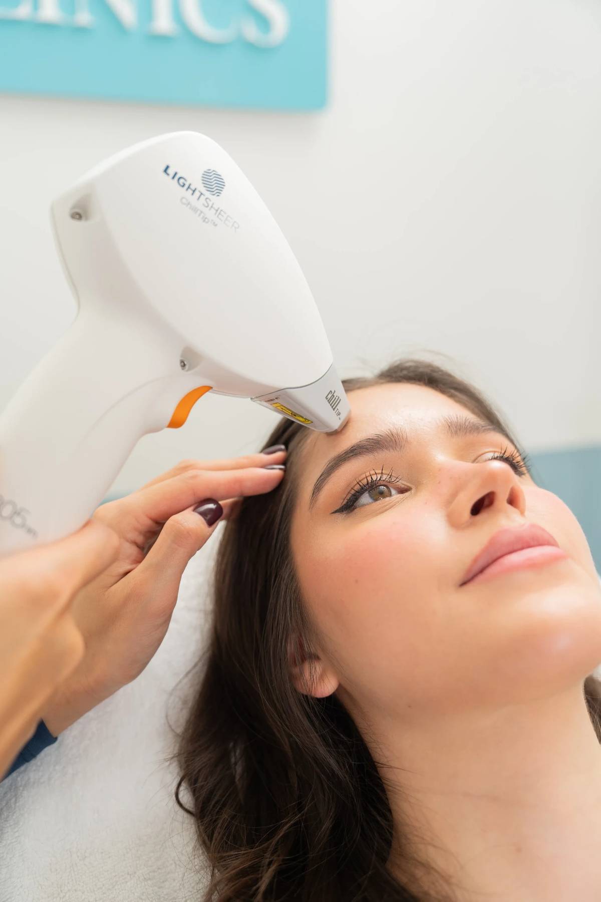 Laser ontharen in het gezicht met de LightSheer bij RB Clinics